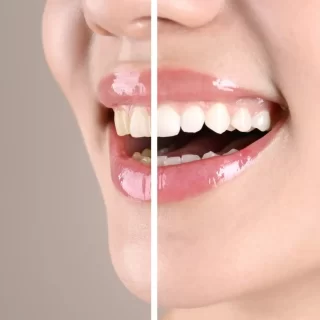 Teeth Whitening Demand Australia