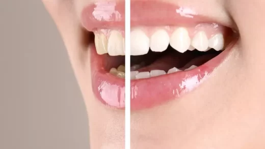 Teeth Whitening Demand Australia