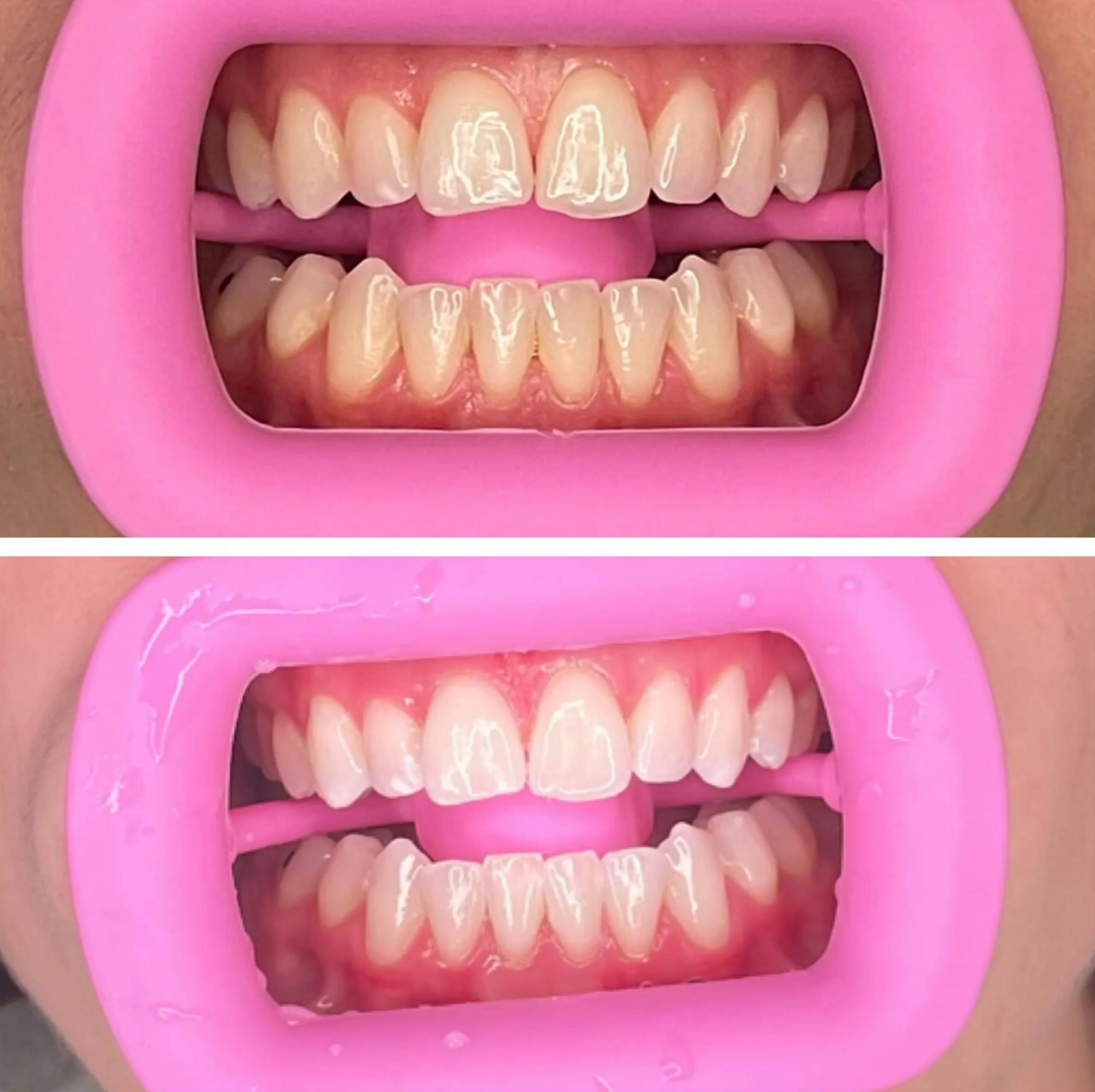 cosmetic teeth whitening trends 2025