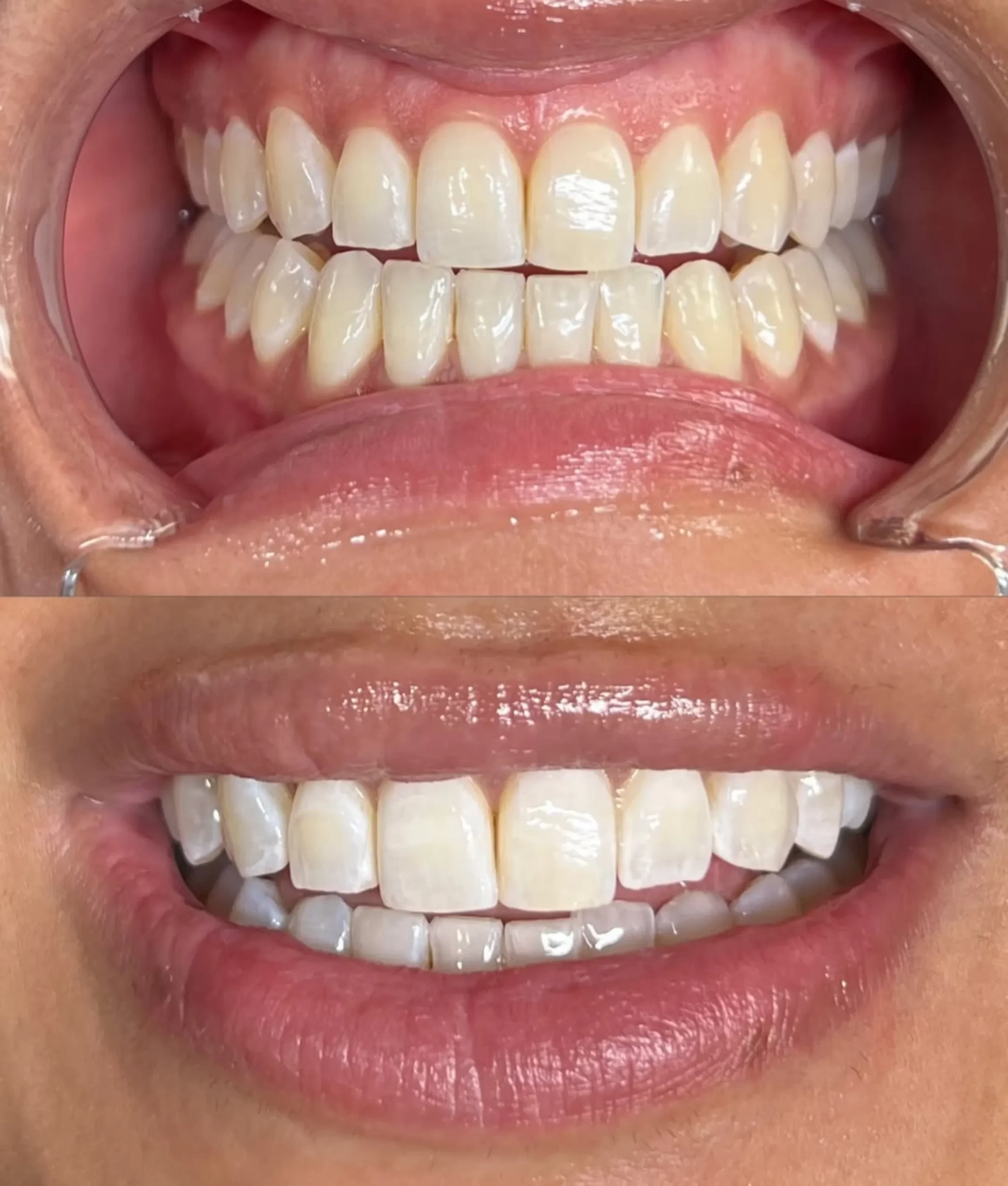 teeth whitening Australia