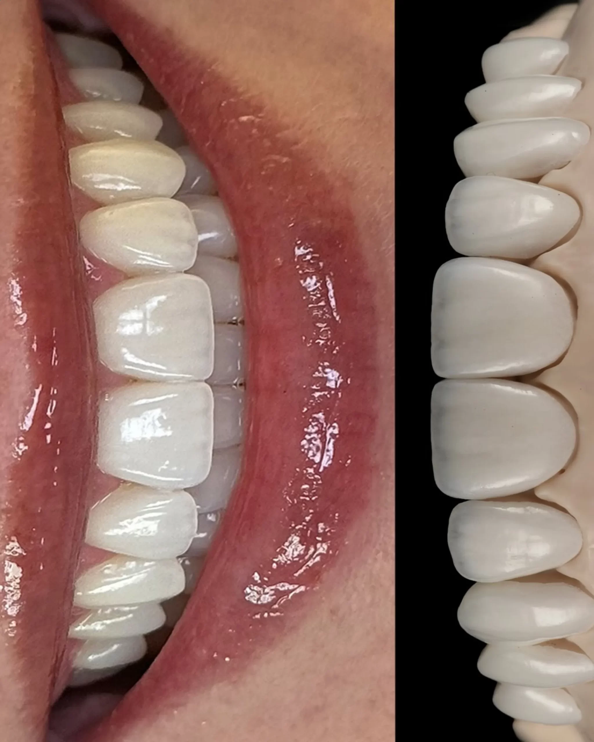 teeth whitening for beauty professionals