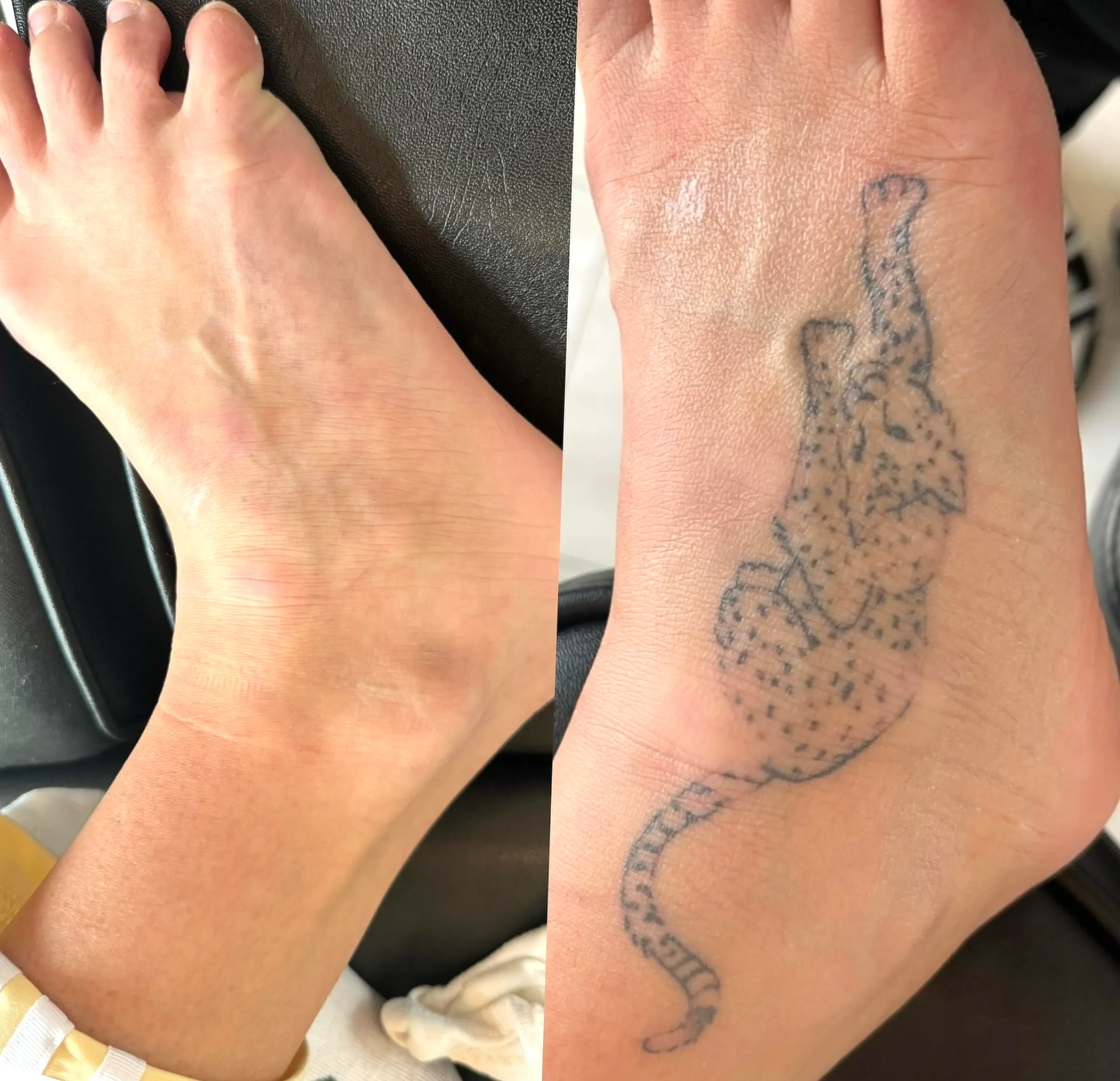certified laser tattoo removal course