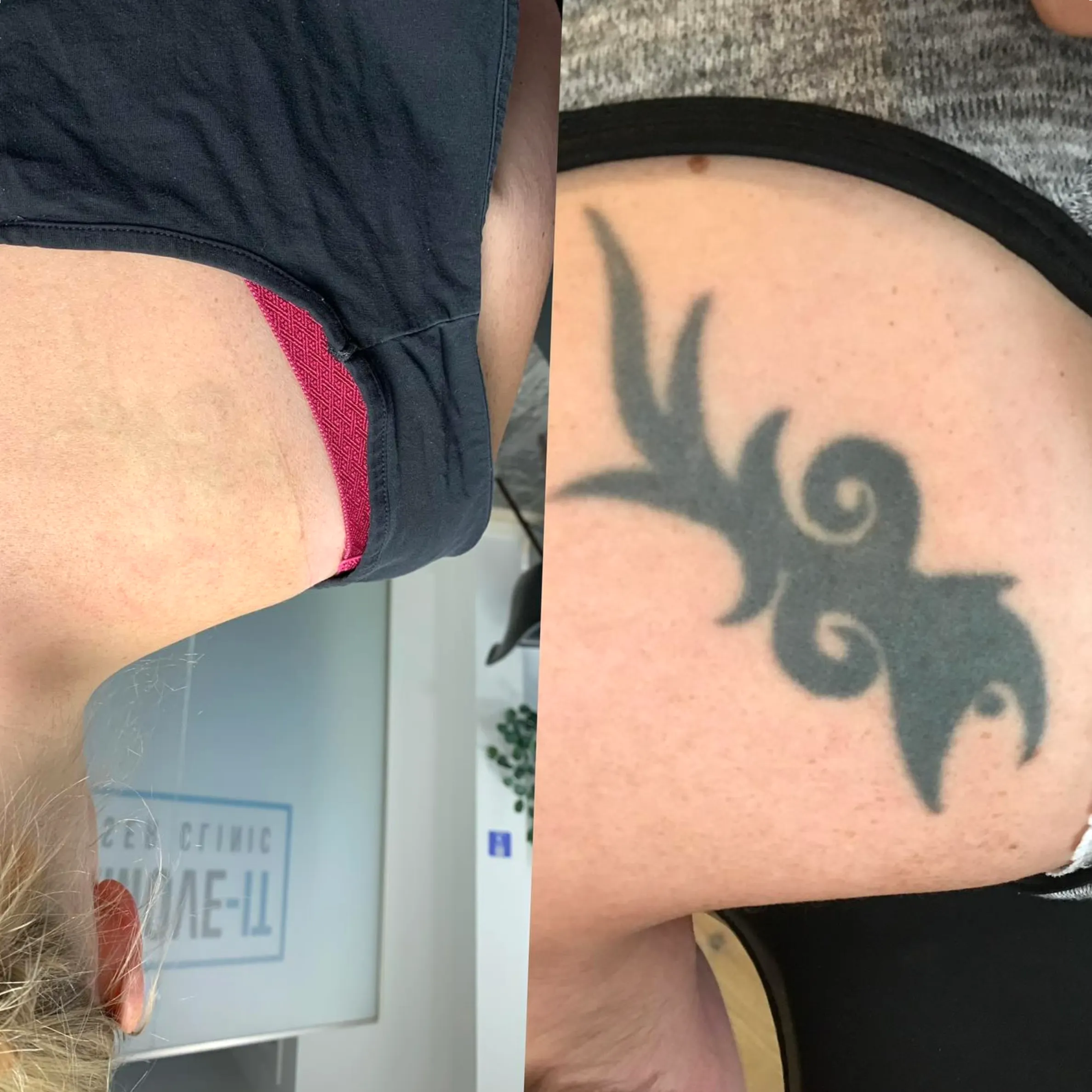 hands on tattoo removal training