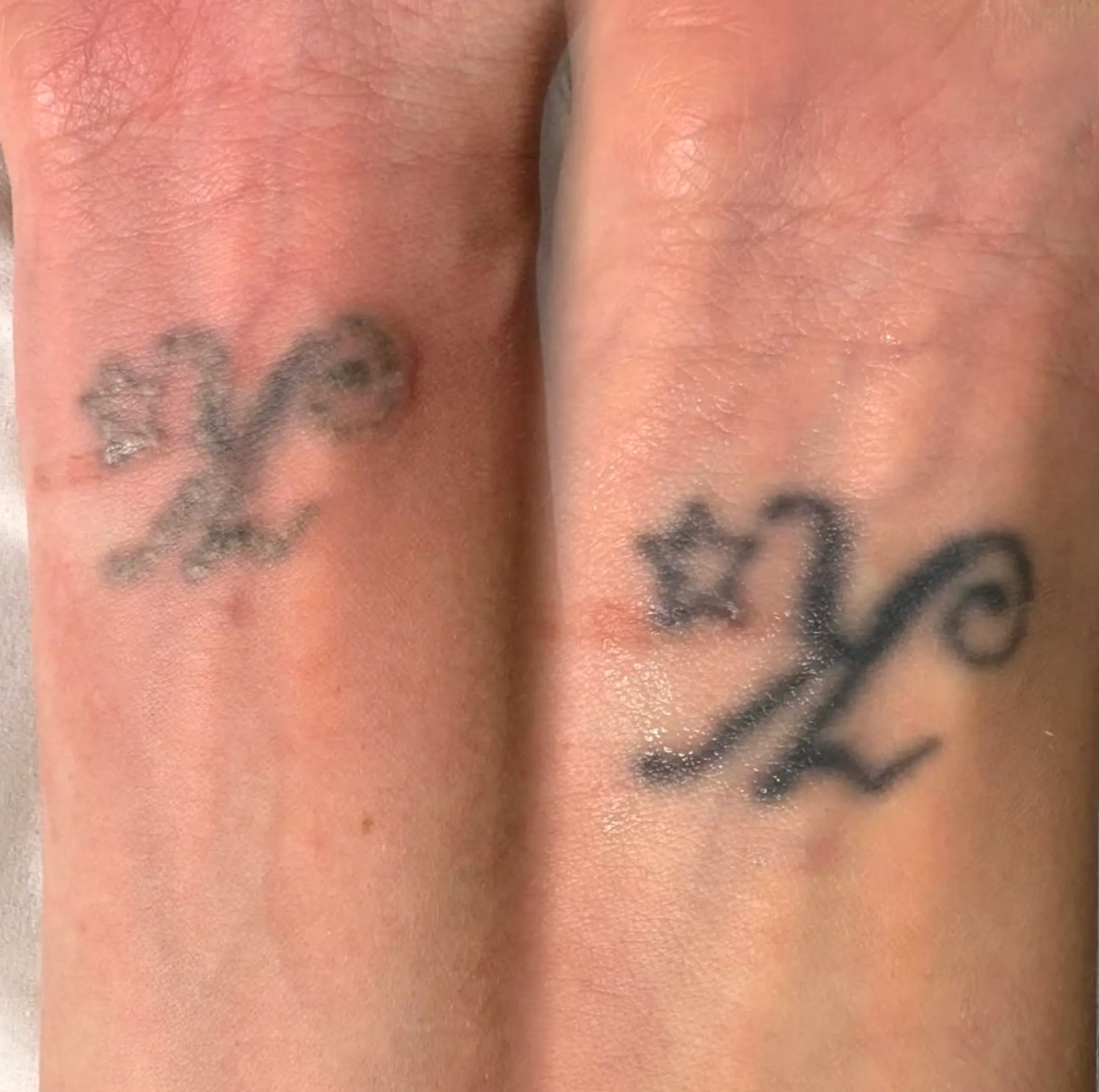 laser safety tattoo removal course