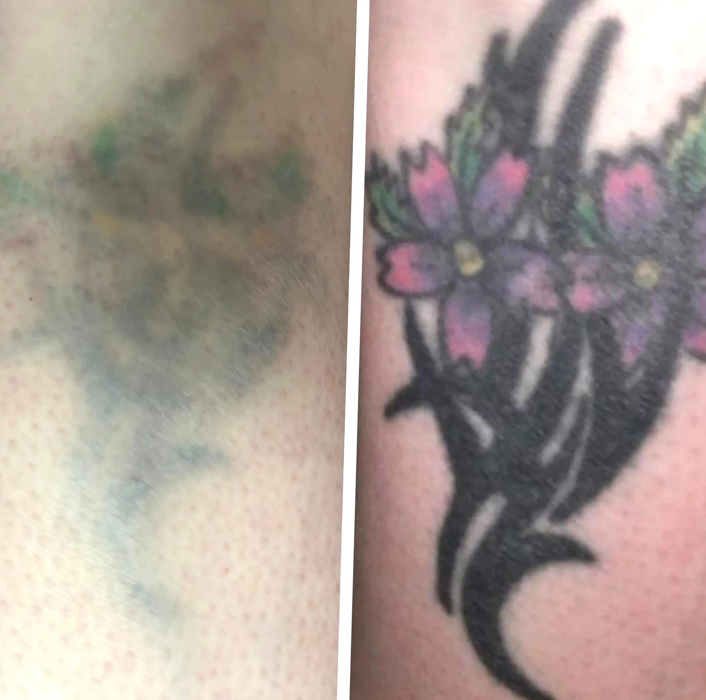 tattoo removal course Melbourne