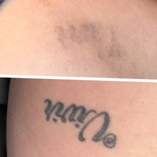 tattoo removal training with live models