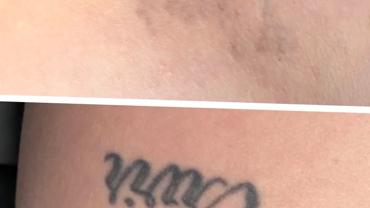 tattoo removal training with live models